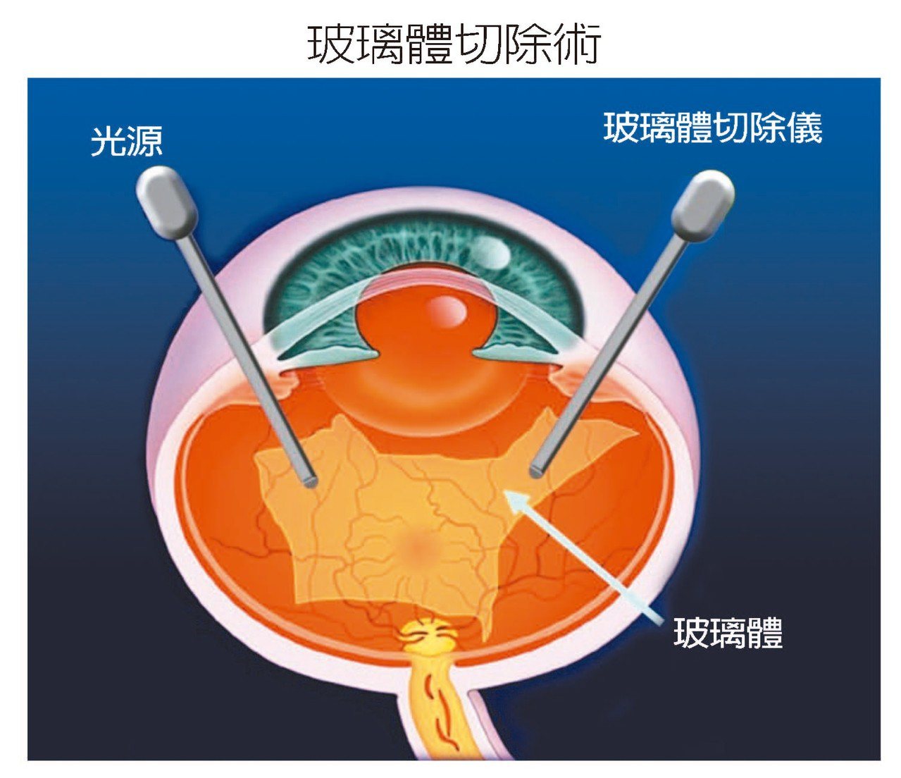 視網膜剝離必須透過玻璃體切除手術，才能讓視網膜復位。