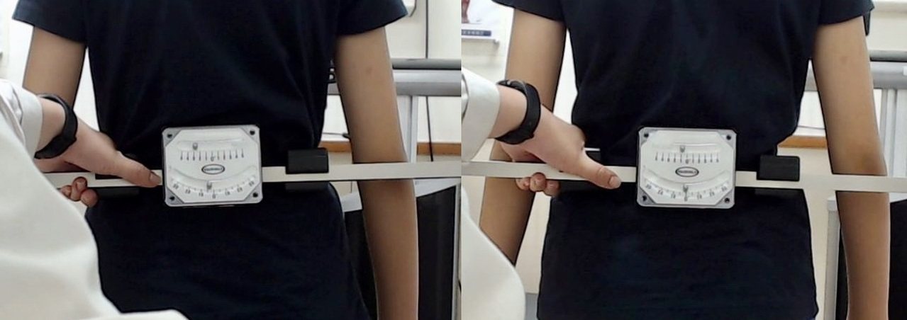 小五生接受KKT聲波動力平衡系統治療前（左）與治療後（右），短短一個月，矯正腰部平衡近3度。 圖／業者提供