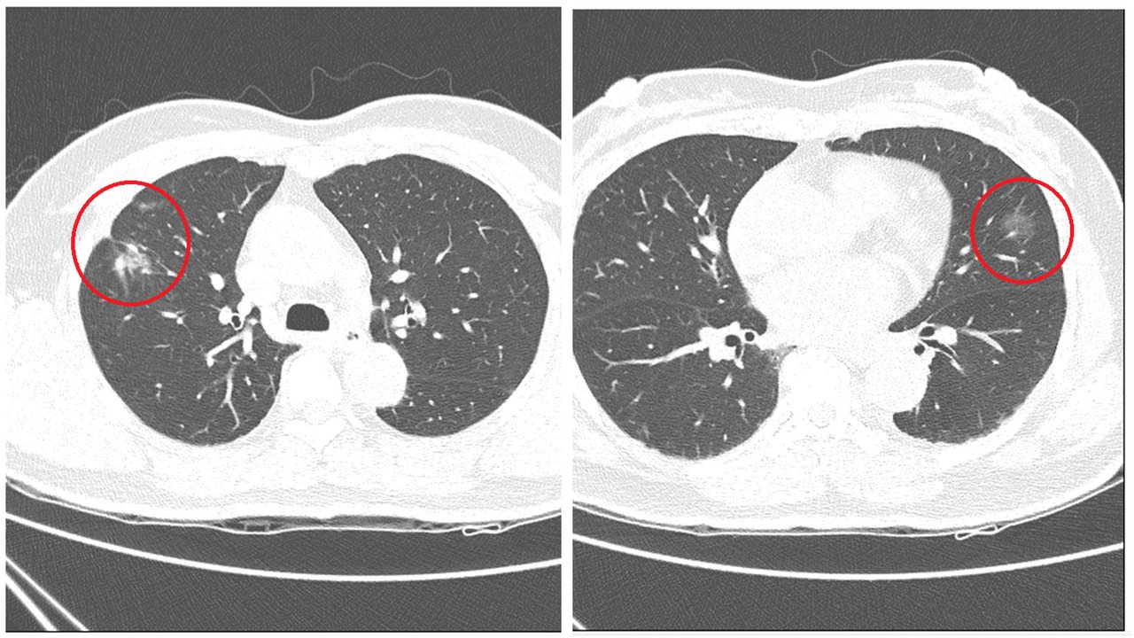張女的電腦斷層顯示兩側肺部各有毛玻璃狀病變。圖／台北慈濟醫院提供