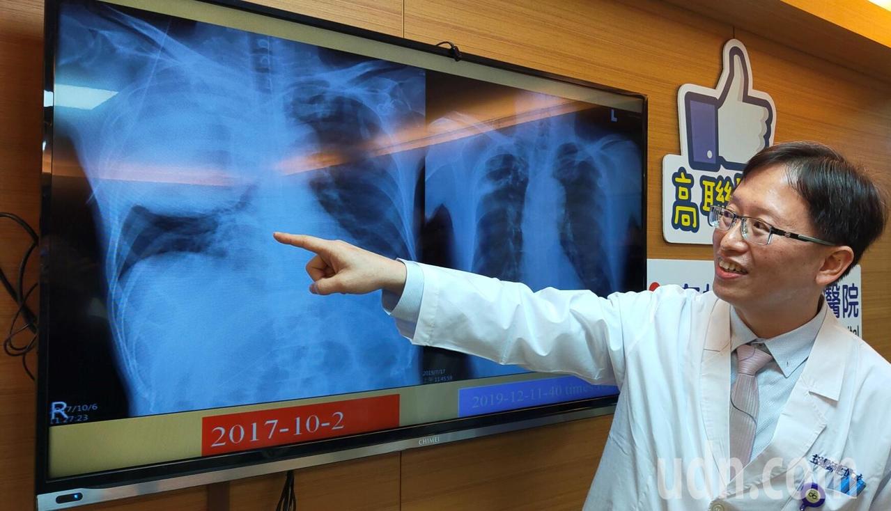 高雄市立聯合醫院胸腔內科主任連偉立表示，林先生2年前接受免疫治療前，腫瘤幾乎占據肺部3分之2（X光片圖左），經2年治療，目前肺部幾乎已無癌細胞。記者蔡容喬／攝影