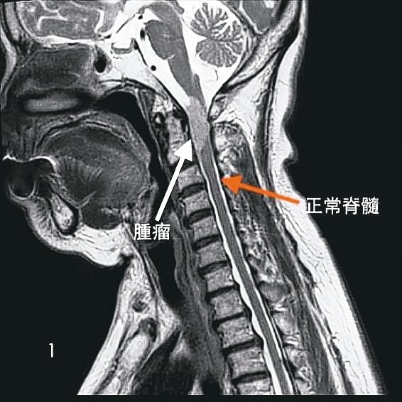 頸椎磁振掃描 矢狀切面<br>
白箭頭：可見淡灰色腫瘤幾乎占據整個脊隨腔<br>
紅箭頭：深灰色長條狀物為正常脊隨<br>