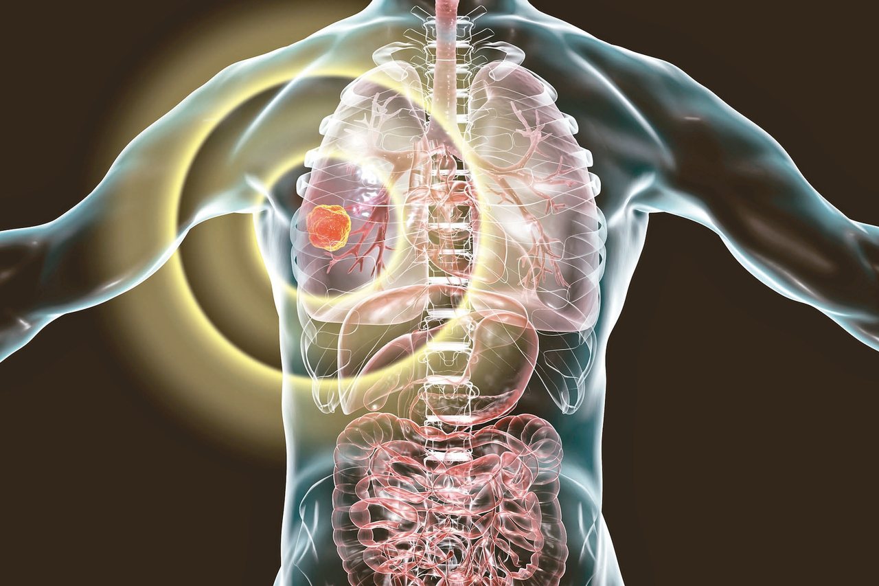 透過基因檢測，讓肺癌病友用對標靶藥物。