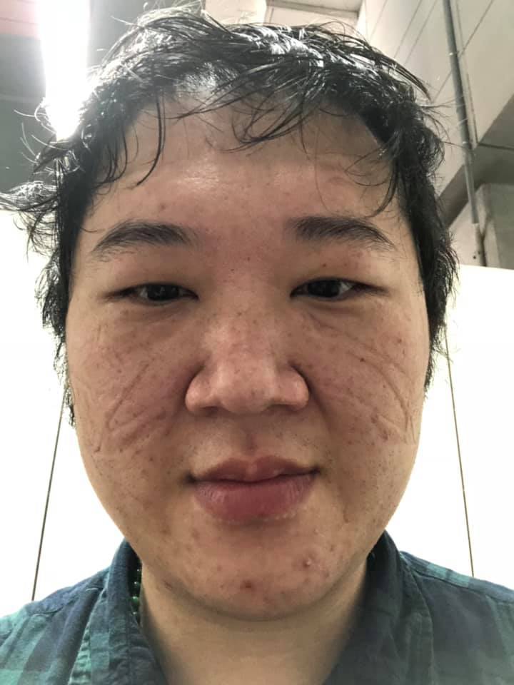 台北市立聯合醫院胸腔科主治醫師鄒冠全在個人臉書貼出一張令人感動的自拍照。照片中的他 ，從鼻樑到兩頰是深深的壓痕。圖／鄒冠全提供