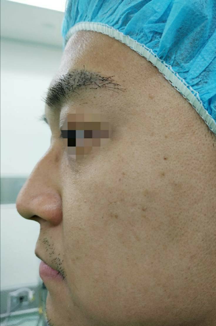 顏先生鼻中膈彎曲，出現明顯的鼻駝峰，接受手術矯正。圖／三總提供