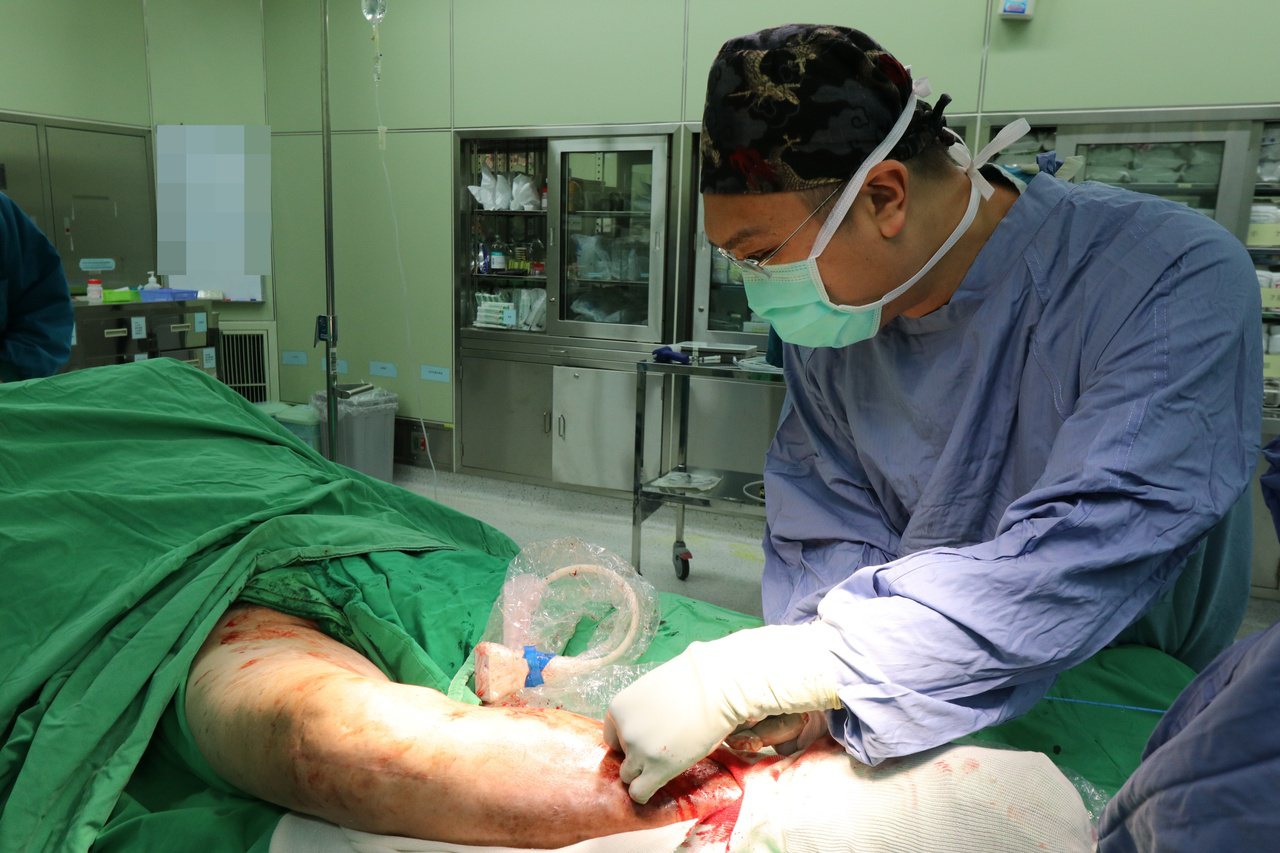 亞洲大學附屬醫院心臟血管外科主任劉殷佐指出，靜脈超級膠水閉合手術時間約1小時內，術後當天即可恢復正常生活，不需穿著醫療用彈性襪。圖／亞洲大學附屬醫院提供