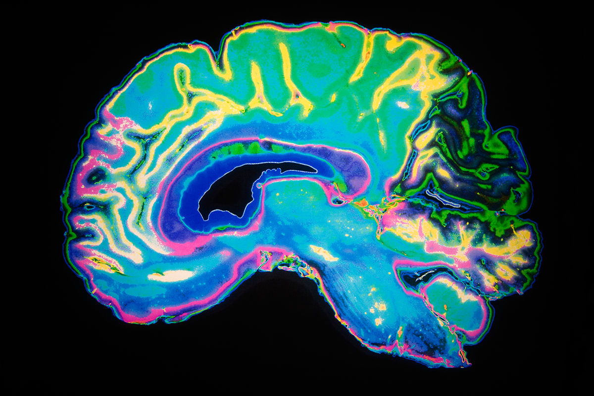 科學界目前猜測，患有阿茲海默症患者的大腦中負責記憶的神經細胞之所以死亡，有多種假說。