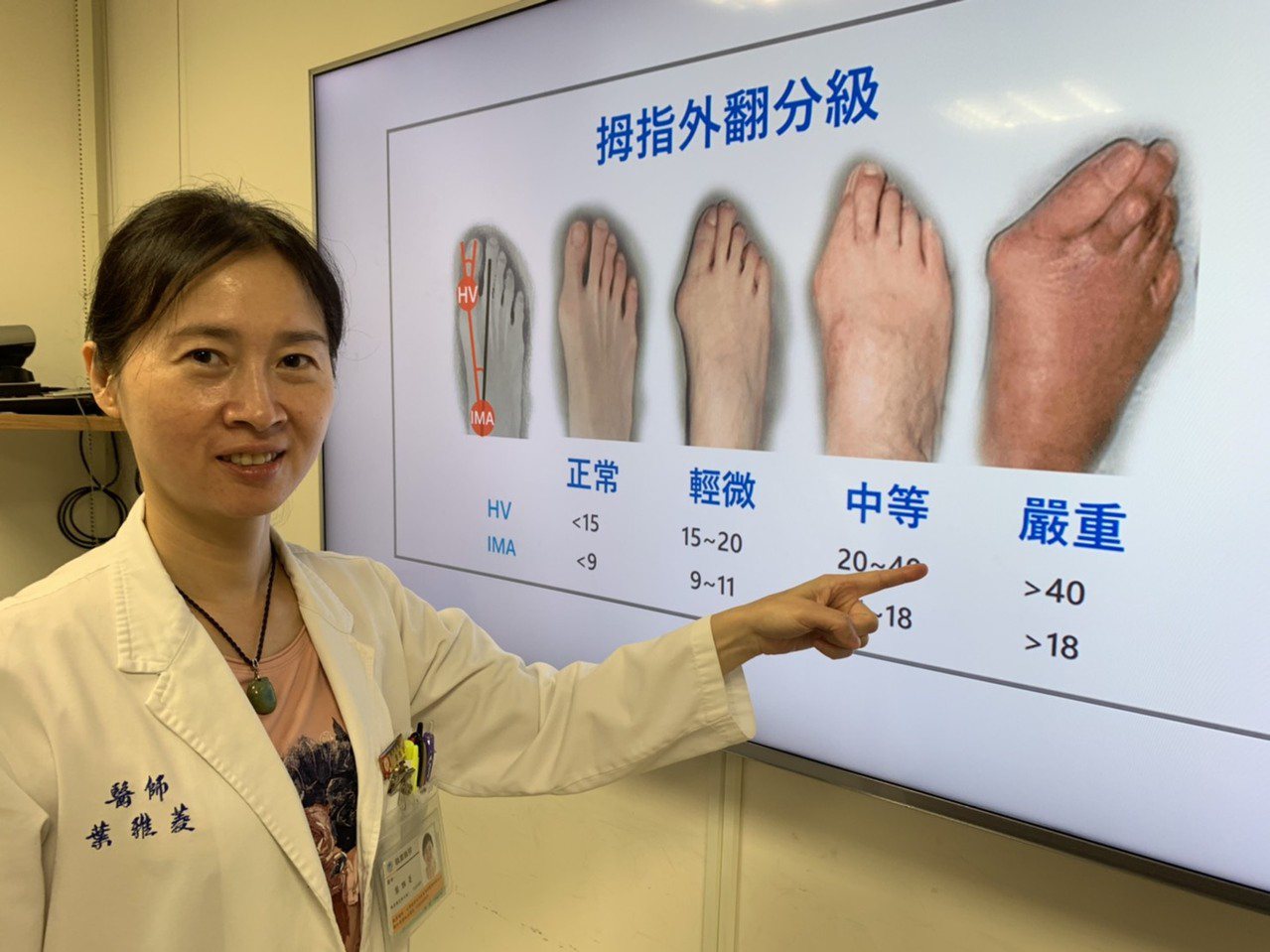 新竹馬偕醫院骨科主治醫師葉雅菱指出，雙腳合上，查看大拇趾是否向第二腳趾傾斜，如果傾斜超過15度，就是拇指外翻。圖／葉雅菱提供