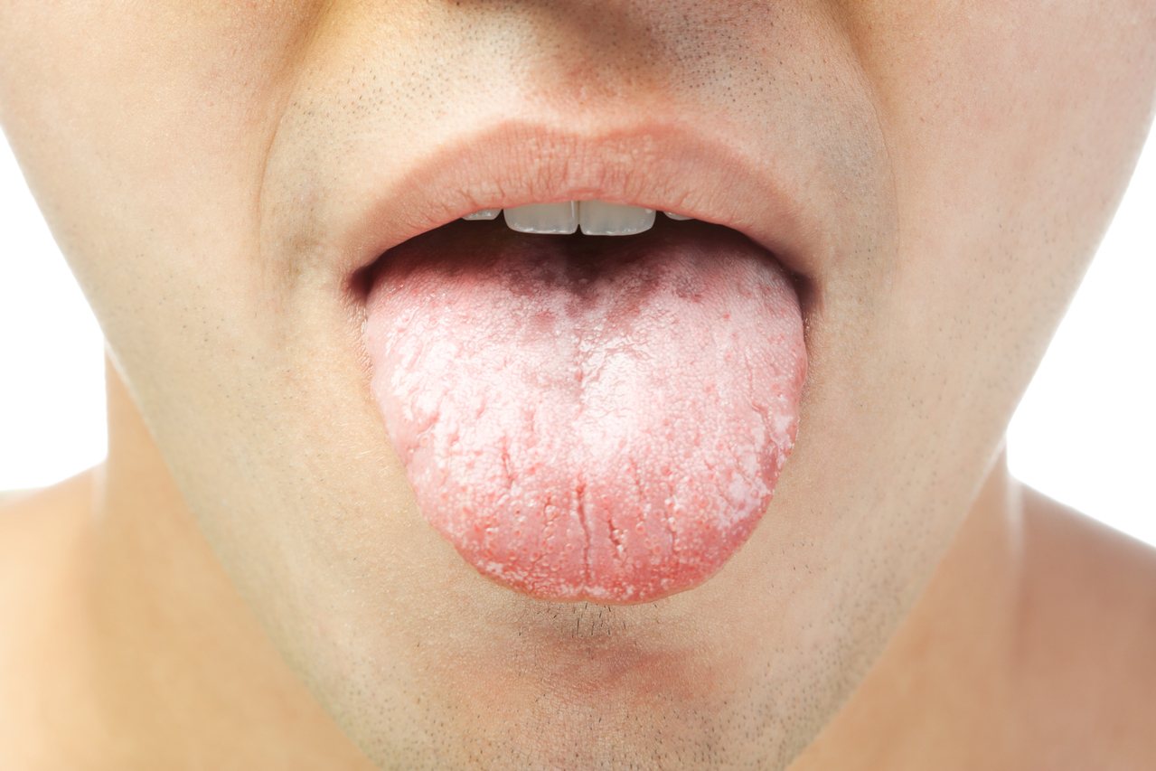 口臭、便祕、嘴破、舌苔黃...是身體累積毒素的表現！圖／ingimage