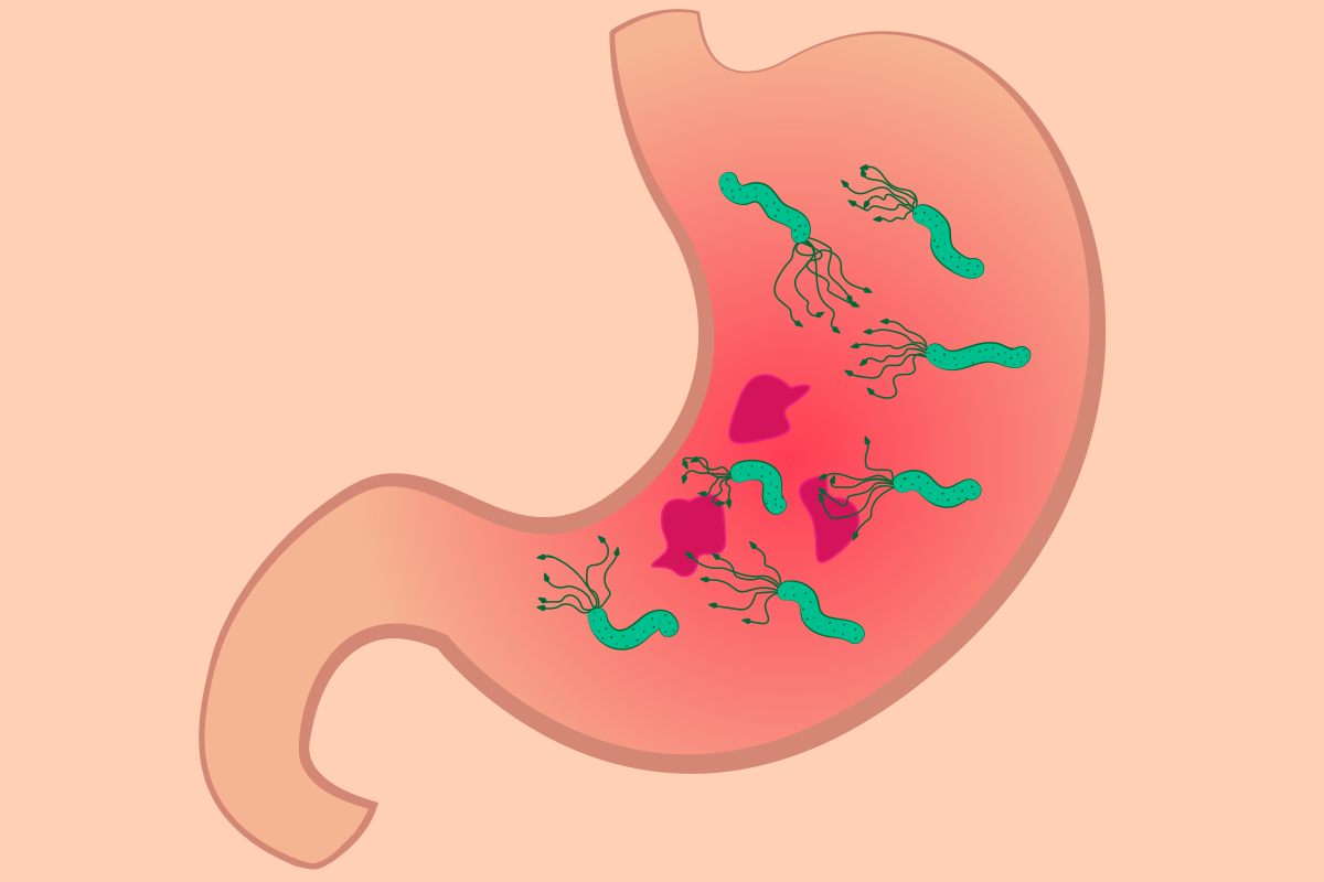 早期胃癌症狀不明顯，包括消化不良、食欲下降、胃脹氣、腹脹等，易與一般胃病，如胃食道逆流、胃潰瘍、十二指腸潰瘍等疾病混淆。