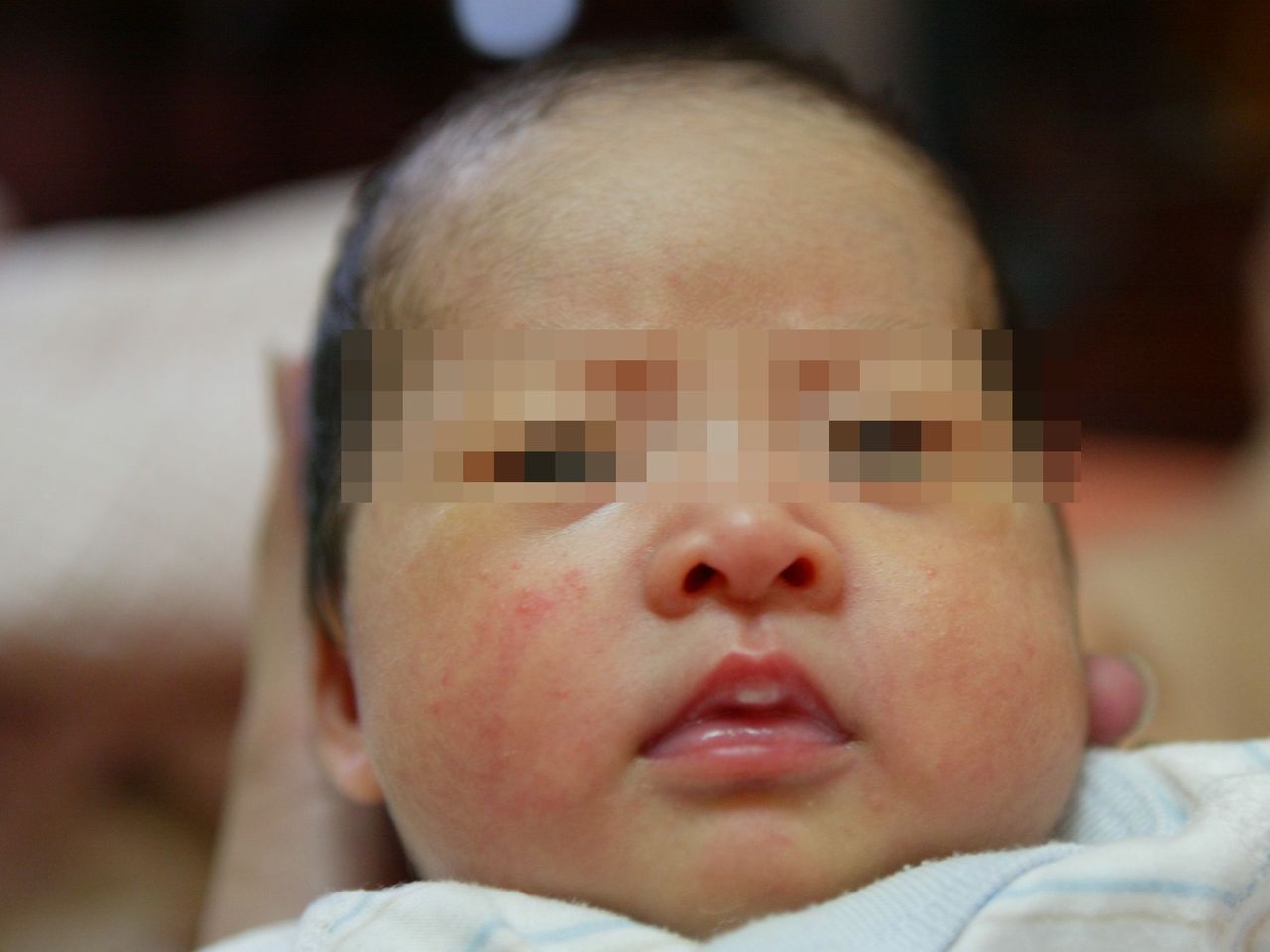 醫師林鴻志認為，新生兒臉上痤瘡若未見改善，或範圍有擴大，需赴醫檢查，以找出其他可能的病因。圖／亞洲大學附屬醫院提供