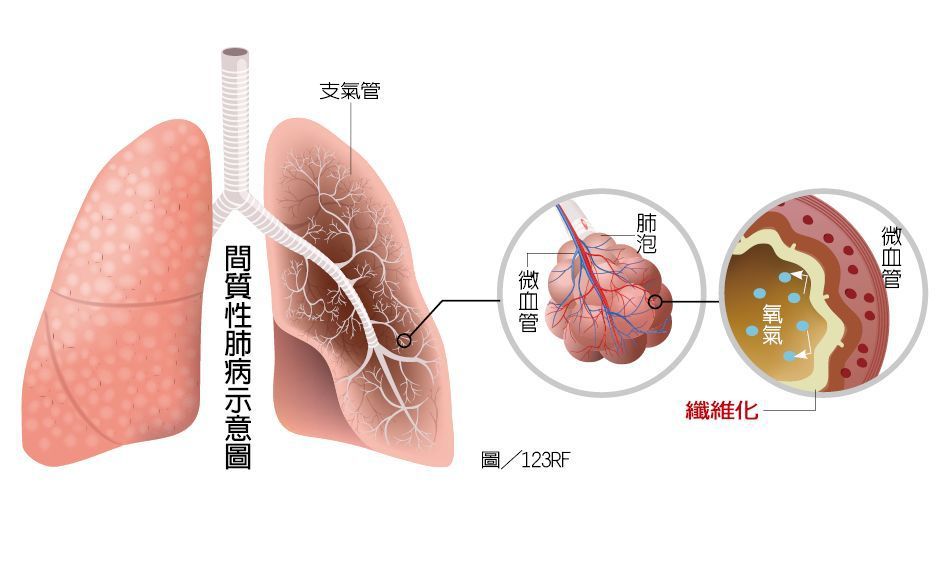 間質性肺病示意圖  圖/123RF  製圖/元氣周報