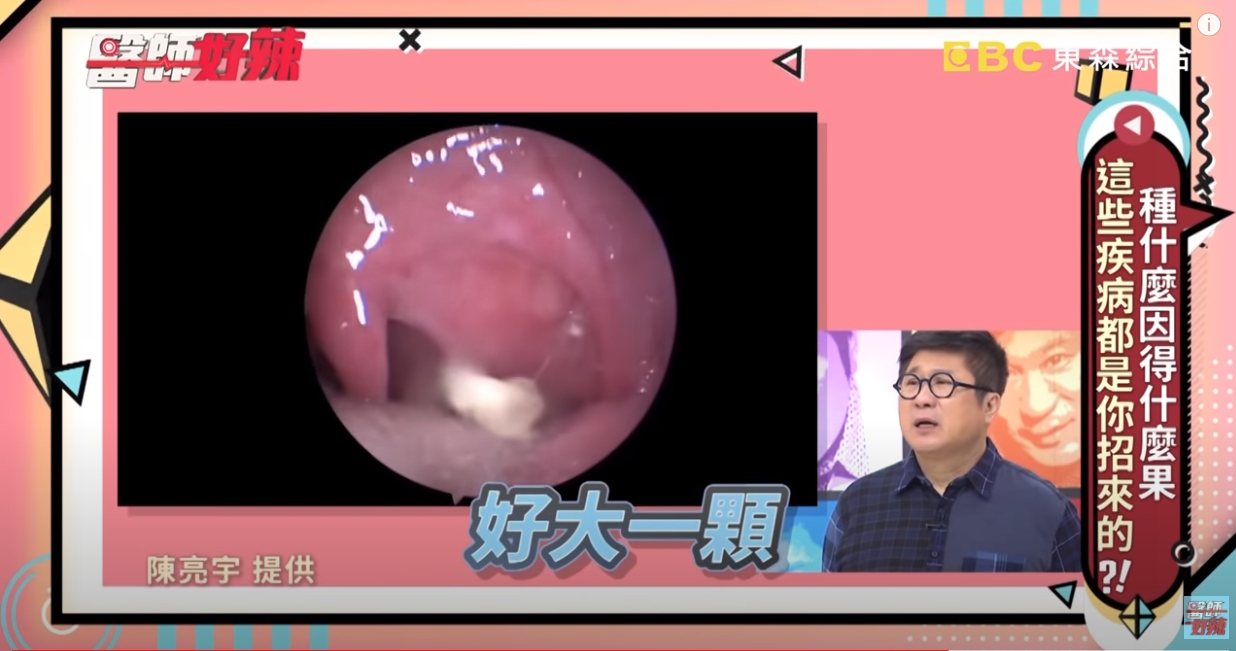 醫生壓出2公分長的扁桃腺結石。圖／截自YouTube