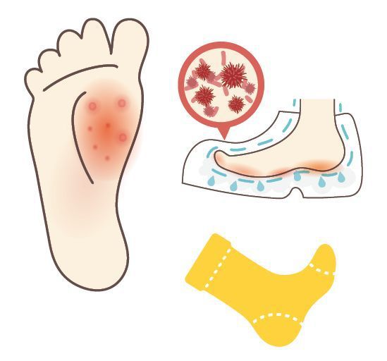 足癬就是俗稱的「香港腳」，潮濕的環境特別容易感染，感染後可能出現多樣形態。圖/123RF