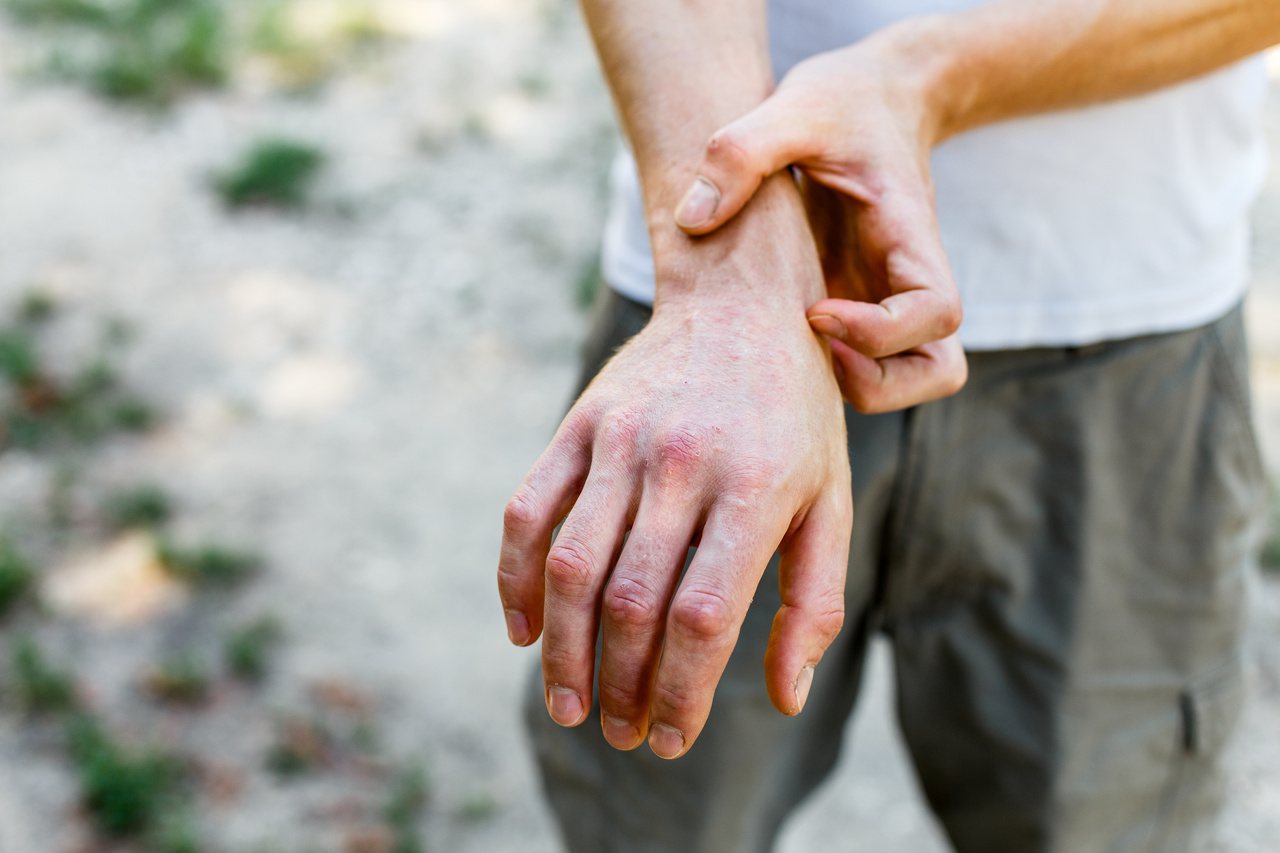 異位性皮膚炎與脂漏性皮膚炎是常見的皮膚疾病，有時會造成混淆，但兩者的成因、症狀不盡相同。圖/123RF
