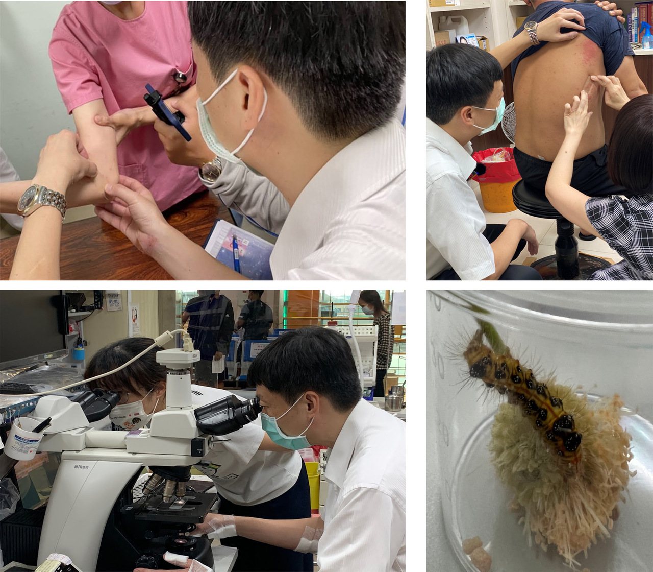 高雄長庚醫院與中山大學聯手，用電子顯微鏡與質譜儀分析，找出紅疹由毛毛蟲剛毛引起的超微構造及生化證據。圖／院方提供