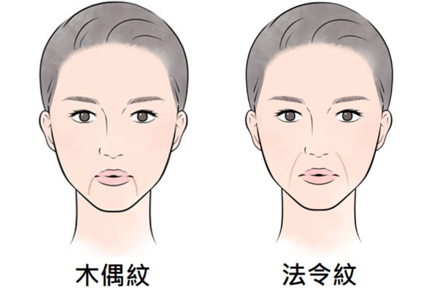 隨著年齡增長，受到肌膚老化、表皮與肌肉的飽滿度與彈性降低等因素影響，臉部也會逐漸出現惱人的紋路。其中，又以兩種在口鼻處的顯眼紋路：木偶紋和法令紋，最容易讓視覺年齡增加。