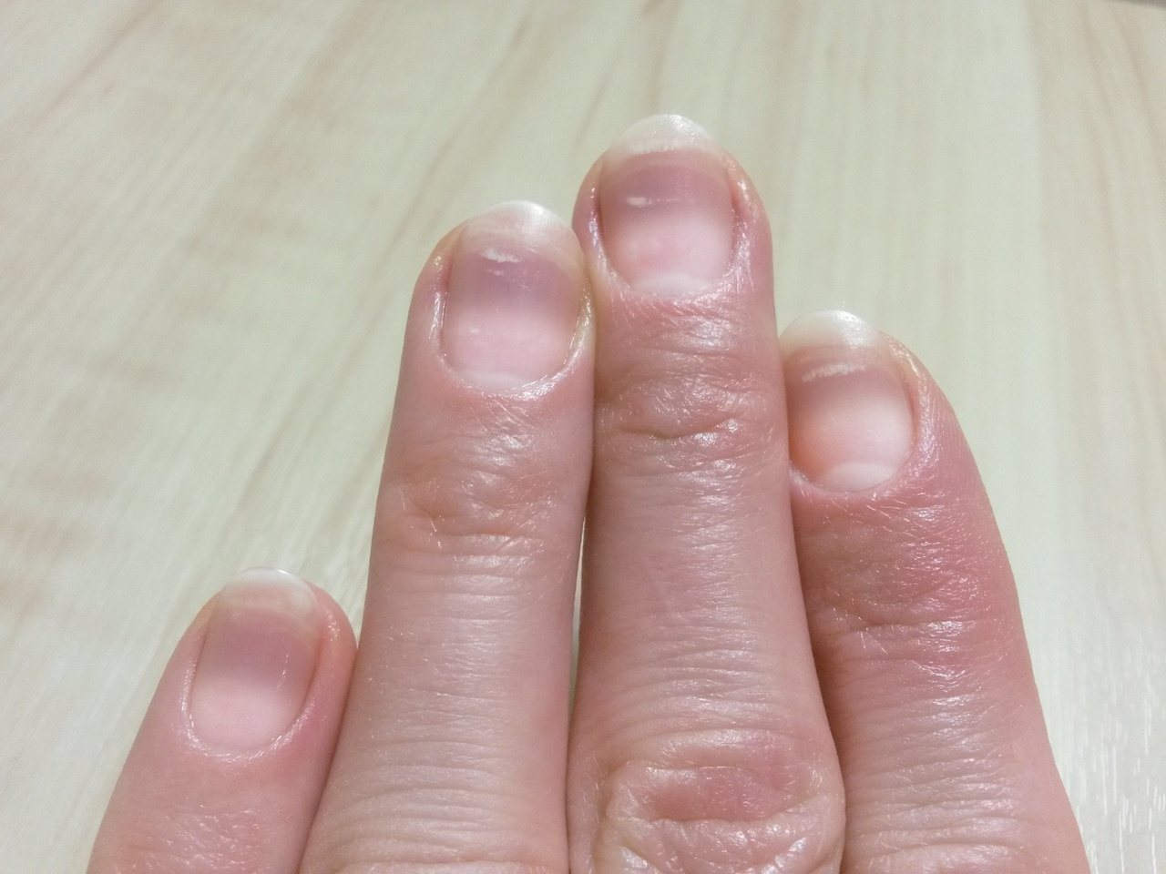 晚期腎臟病症狀可能出現在指甲，呈現「棕白半分」，遠心端呈現紅棕色，近心端呈現濁白色。圖／123RF