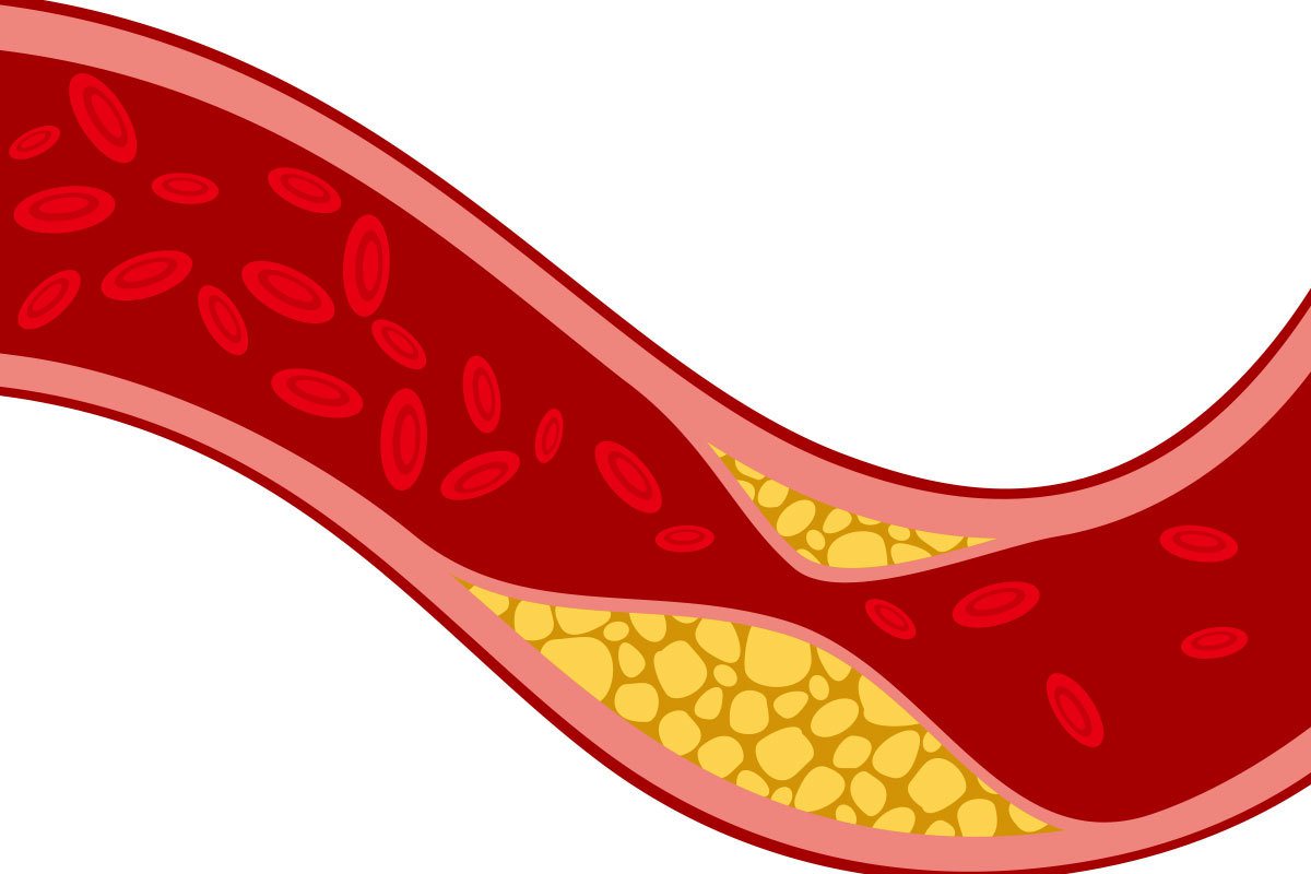 低密度脂蛋白（LDL）會引起心血管疾病，因為它在人體含量如果偏高，容易引發一連串的化學反應，導致心血管出現問題。示意圖，圖片來源：ingimage。
