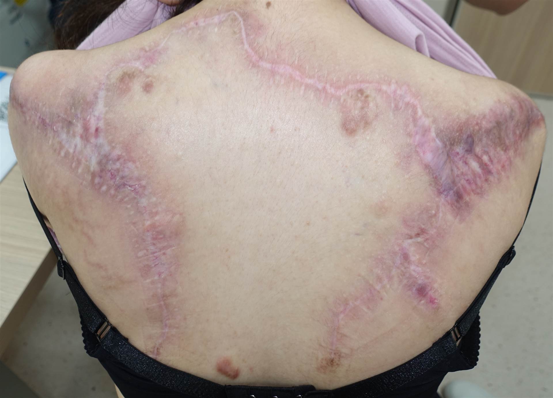 27歲陳小姐10多年前因背部的青春痘反覆感染引發皮膚蟹足腫，從後背蔓延至前胸，15年來持續治療，卻效果不佳，最後尋求基隆長庚團隊協助，才完成切除治療。圖／長庚醫院提供