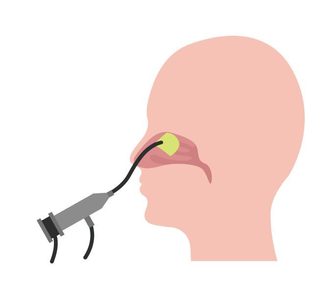 鼻咽喉內視鏡檢查可檢視鼻竇開口的堵塞情形，若是被鼻息肉堵住，光吃藥效果不好，建議到醫院做內視鏡手術，切除息肉，才能暢通鼻竇。圖╱123RF