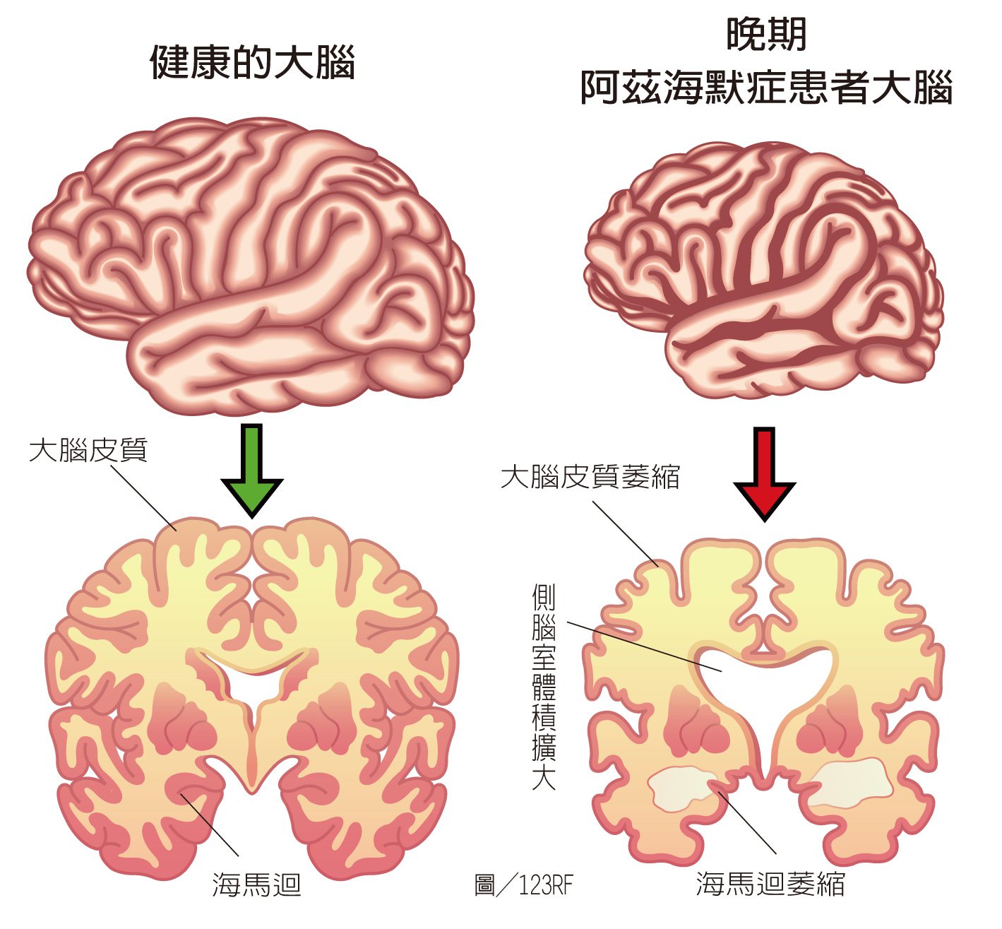 健康大腦與阿茲海默症患者大腦  製表/元氣周報   圖/123RF