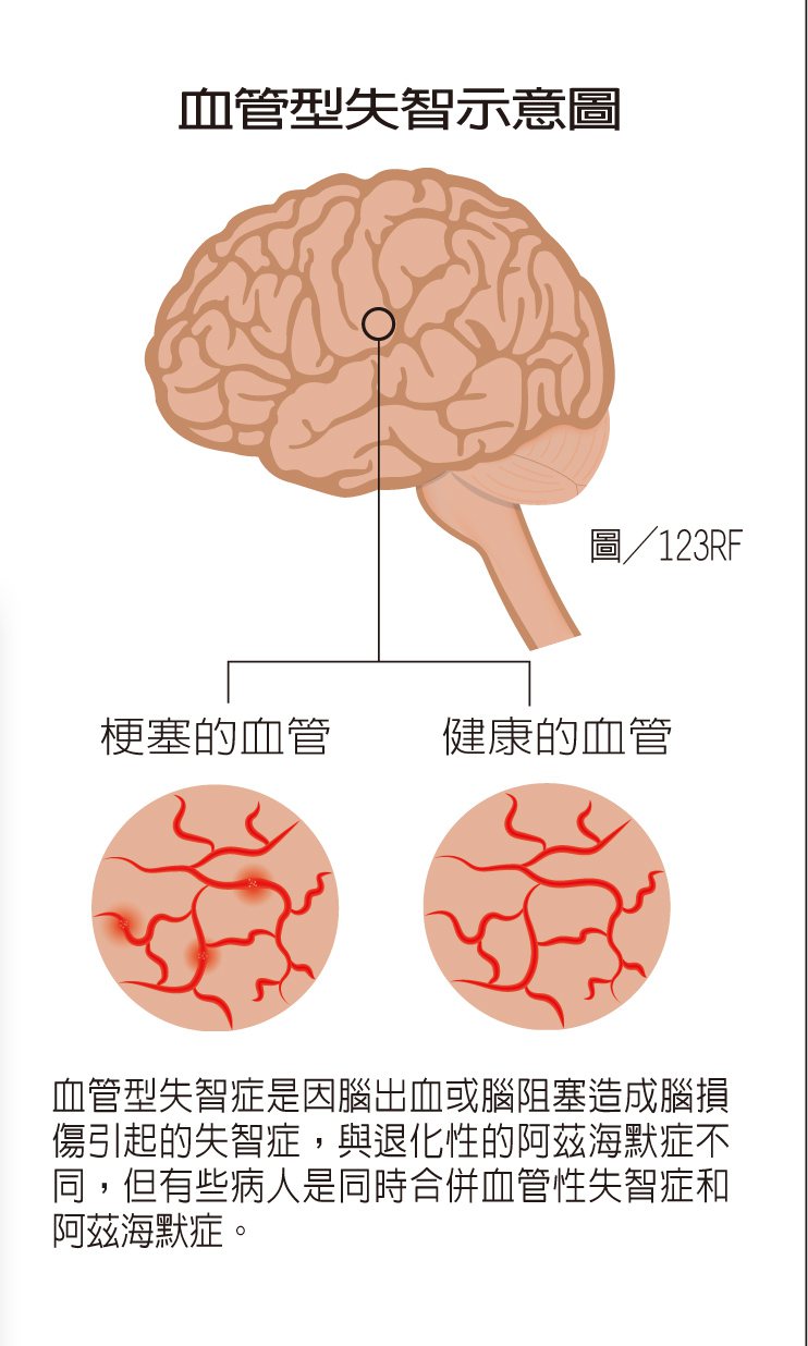 血管型失智示意圖  製表/元氣周報   圖/123RF