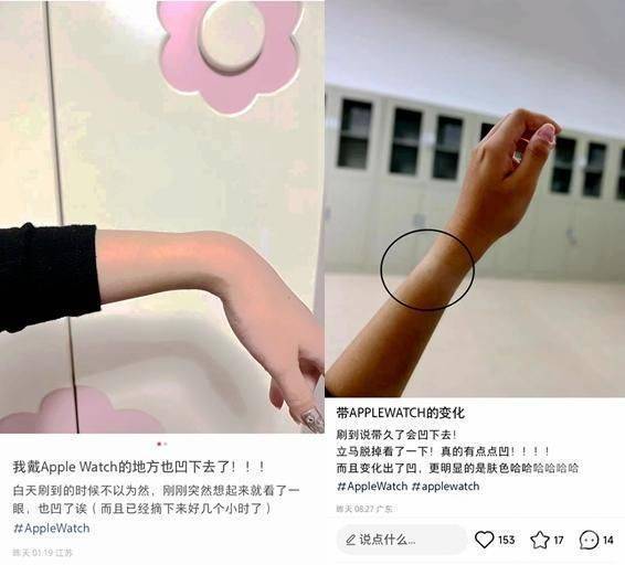 中國網友發現配戴蘋果手錶可能會有手部凹陷、疼痛等狀況，引發討論。翻攝自香港01