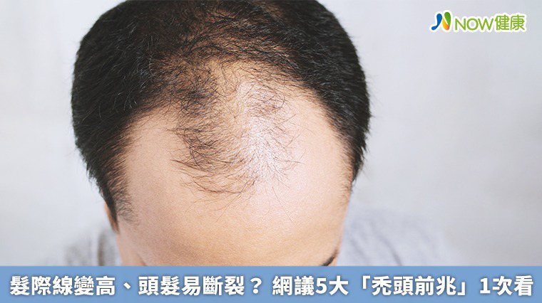 ▲「髮線變高」是網友認為最常見的禿頭前兆之一，也是最容易觀察出開始禿頭的徵兆。（圖／NOW健康製作；圖片來源／ingimage）