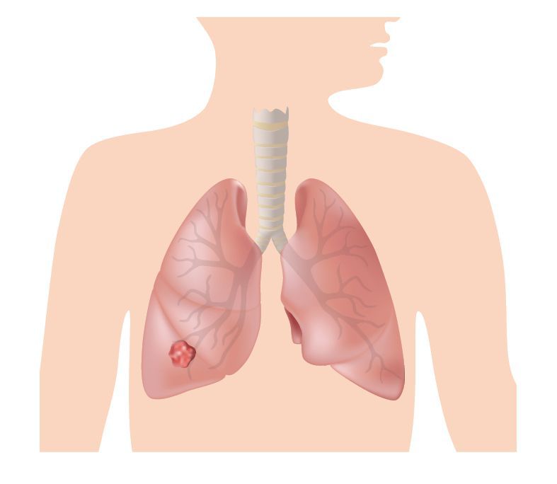 肺癌第一期肺癌的五年存活率達90%，第四期只剩10%。圖/123RF