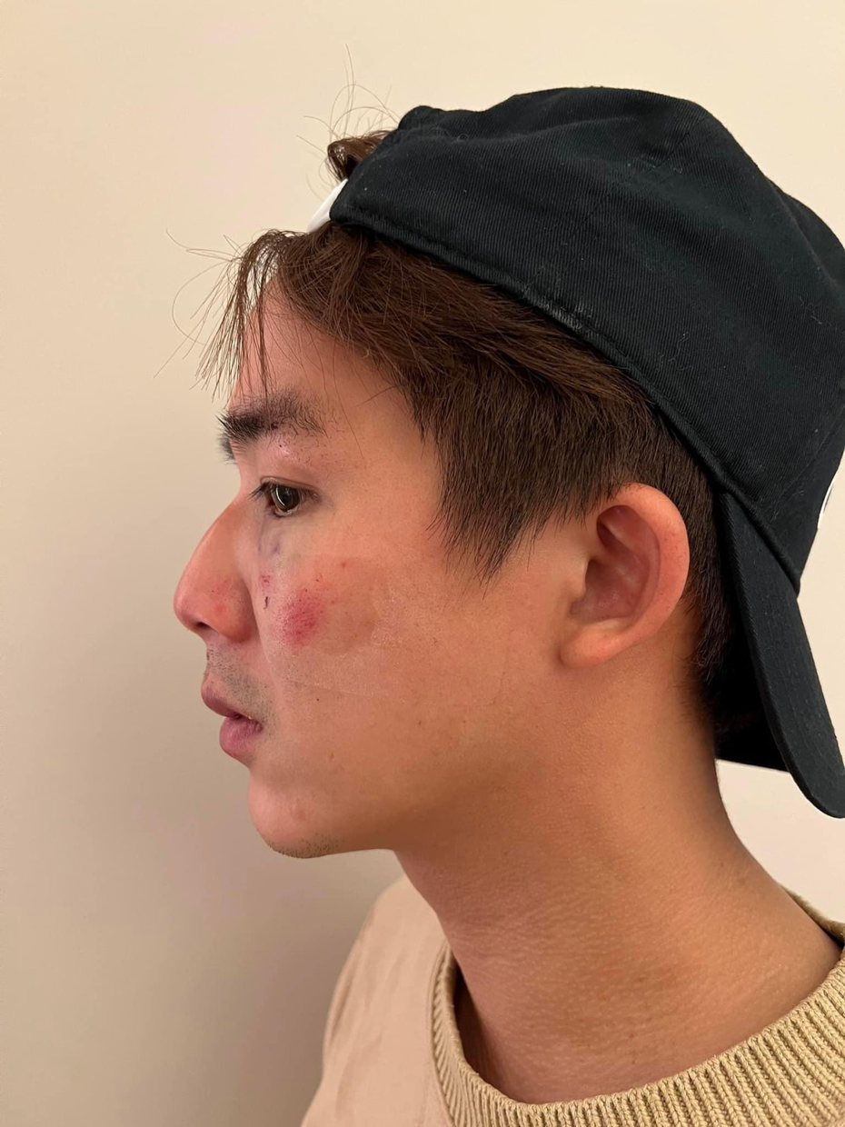 李博翔街头遭殴打，伤势曝光。图／摘自脸书