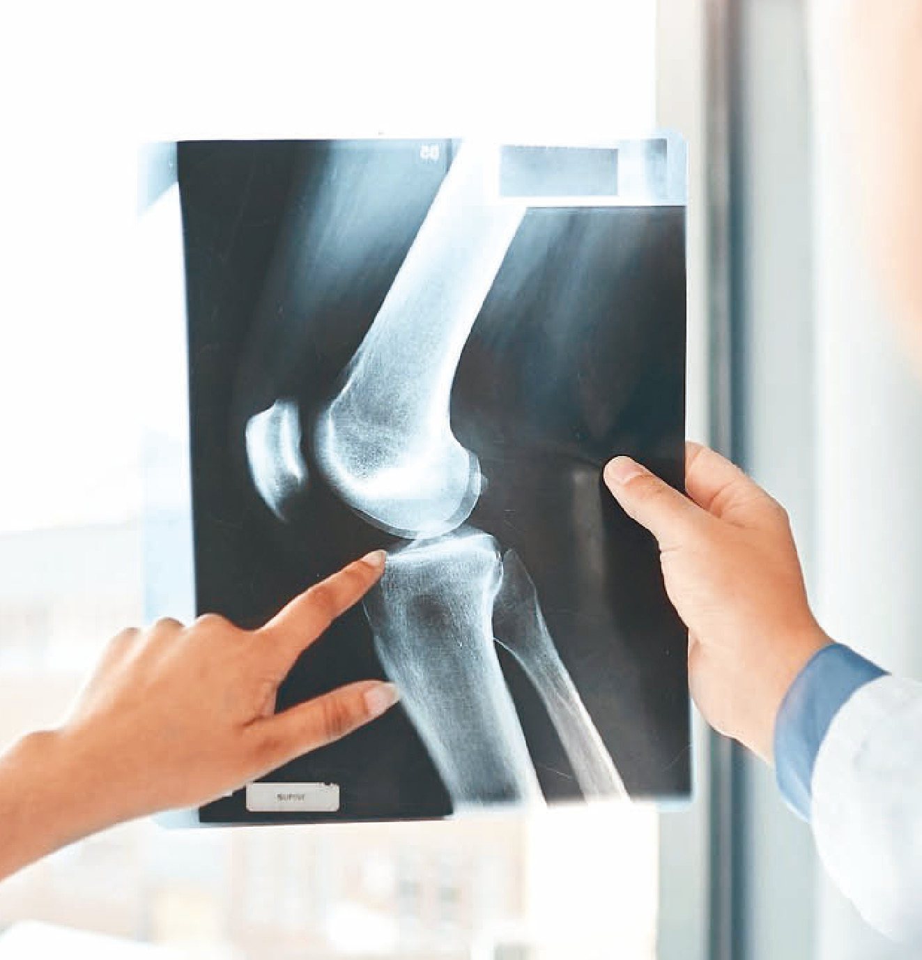 許多人認為「骨裂」或「線性骨折」比較不嚴重，事實上，只要骨頭的連續性被破壞就是骨折。圖／123RF