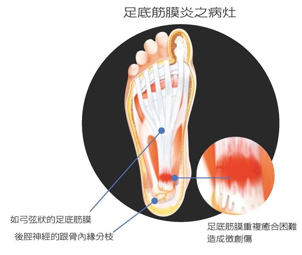 腳底痛 足底筋膜炎有這些症狀要注意 骨科 復健 科別 元氣網