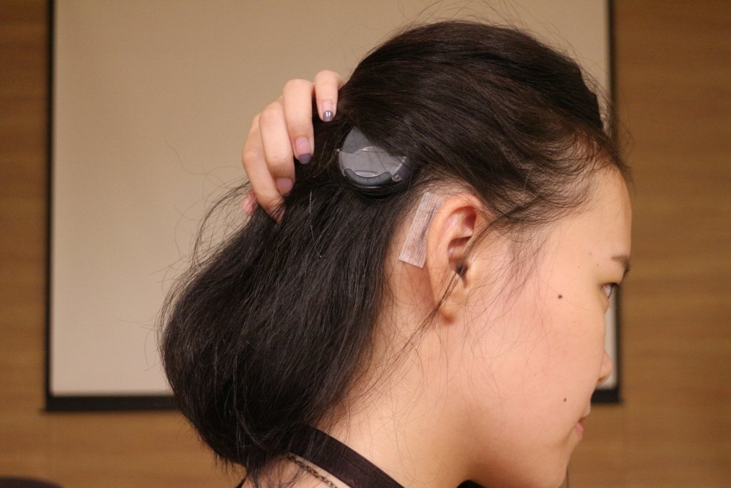 「人工電子耳」手術會於耳後方開三至四公分傷口，將「電極束」植入人體（耳蝸），並從...