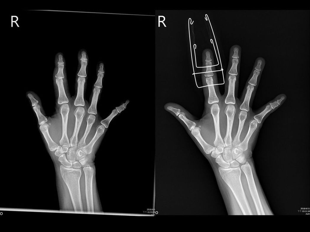 女大學生手指腫痛竟是骨折惹禍 骨科 復健 科別 元氣網