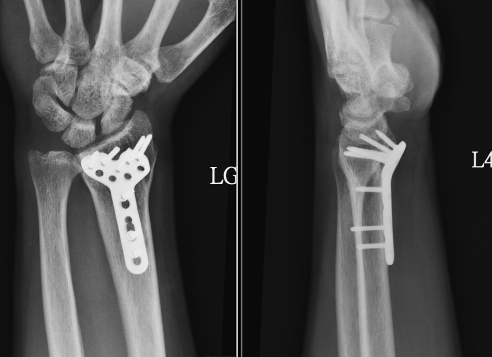 手腕腳踝骨折手術只要局部麻醉高榮50例發表國際期刊 骨科 復健 科別 元氣網