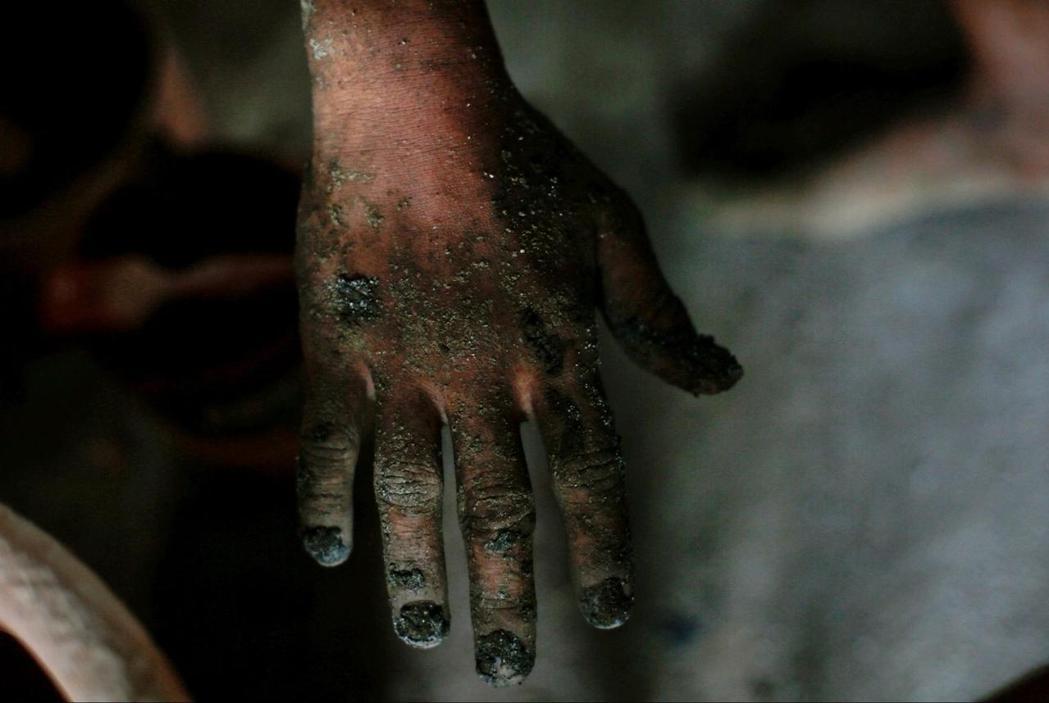 許多童工因壓縮機採礦而患上皮膚炎、身體疼痛、汞中毒等疾病。　 圖／歐新社　