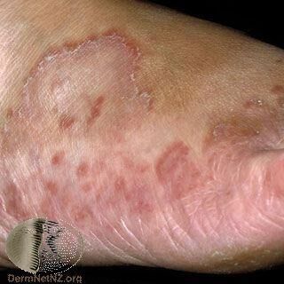 得香港腳最常見原因是被感染 醫師教怎麼根治與預防 皮膚 科別 元氣網
