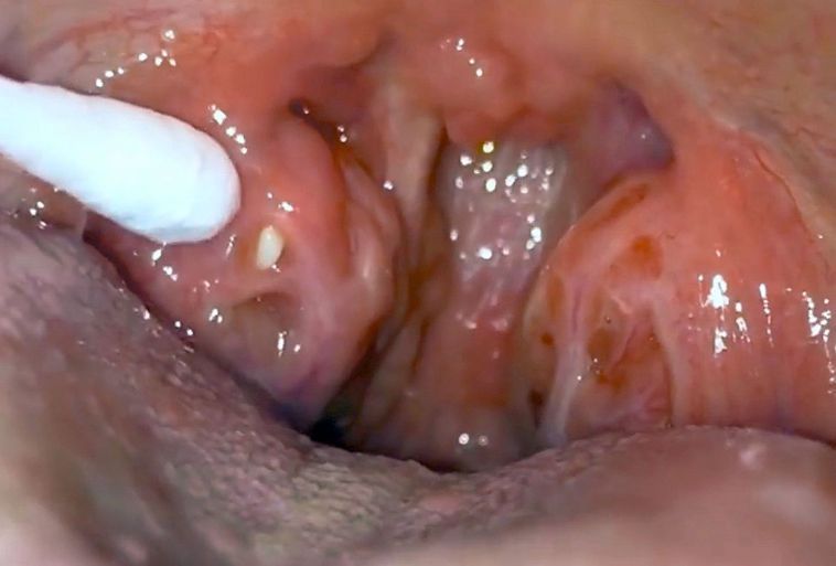 吐出蟲卵般小顆粒 口氣 逼人小心扁桃腺結石 耳鼻喉 科別 元氣網