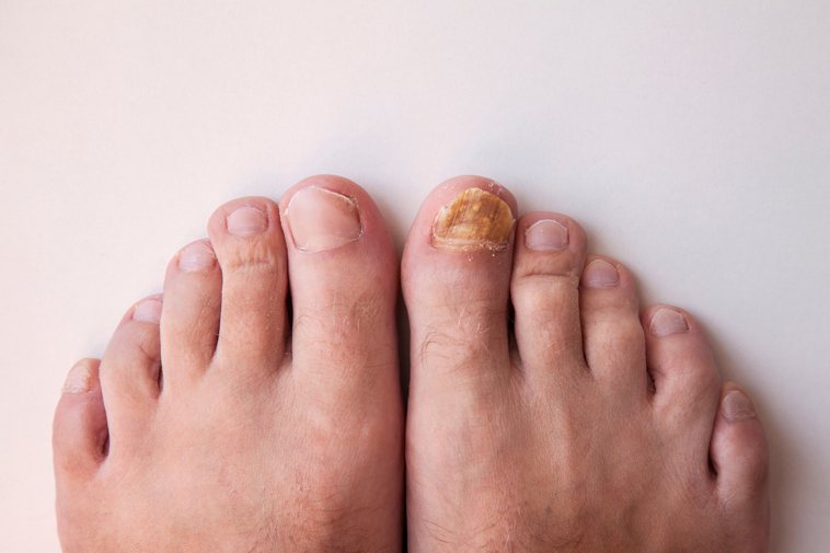 為什麼我的香港腳 灰指甲都看不好 皮膚科醫師先導正你2個ng觀念 指甲 足部 科別 元氣網
