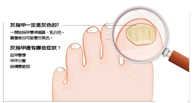 多伴隨香港腳出現 皮膚科醫師教你這樣做預防灰指甲 指甲 足部 科別 元氣網