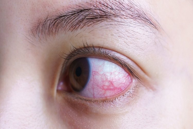 已有 結膜炎眼睛紅癢怎麼辦 千萬不要揉 眼科名醫教你應急作法 眼部 科別 元氣網