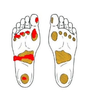 糖友要經常檢查腳底7個受壓點（紅色標示點），有沒有傷口，避免產生病變。圖／陳...