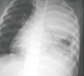 大葉性肺炎遽增兒童老人速就醫 呼吸胸腔 健康百科 元氣網