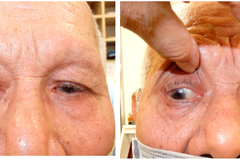 比眼睛大的眼窩腫瘤 北榮導航手術讓患者奇蹟恢復視力