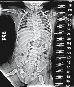 一歲半的小女娃胸椎第11節脊椎發育不良，是扭曲的三角形，導致先天型脊椎側彎，必須利用手術矯正。（台北榮總／提供）