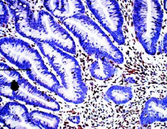 31歲就得結腸癌的女性，醫院檢驗她的癌細胞組織切片，發現她的DNA修復蛋白失去表現（如圖紫色圖案），才會年紀輕輕就有結腸癌。（圖片提供／台北榮總）