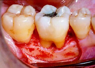 過去清除牙周囊袋內深部結石，只有傳統手術一途。（圖片提供／李德孚醫師）