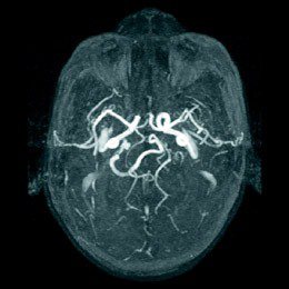 腦部核磁共振血管攝影影像，箭頭處後交通動脈，發育不全，管徑過細，無法提供周邊血管側枝循環，是最早被公認為腦中風的解剖學危險因子之一。（圖片提供／莊毓民醫師）