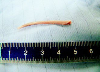 台中市一名婦人因雞骨頭刺穿胃壁造成腹膜炎，醫師開刀取出長約四公分的骨頭。（照片／澄清醫院提供）