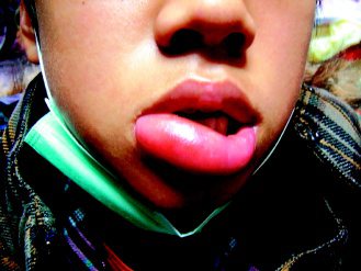 十三歲李姓男童曾遭小黑蚊叮到嘴唇，隨即嚴重紅腫，把父母親嚇壞了。（記者楊正敏／攝影）